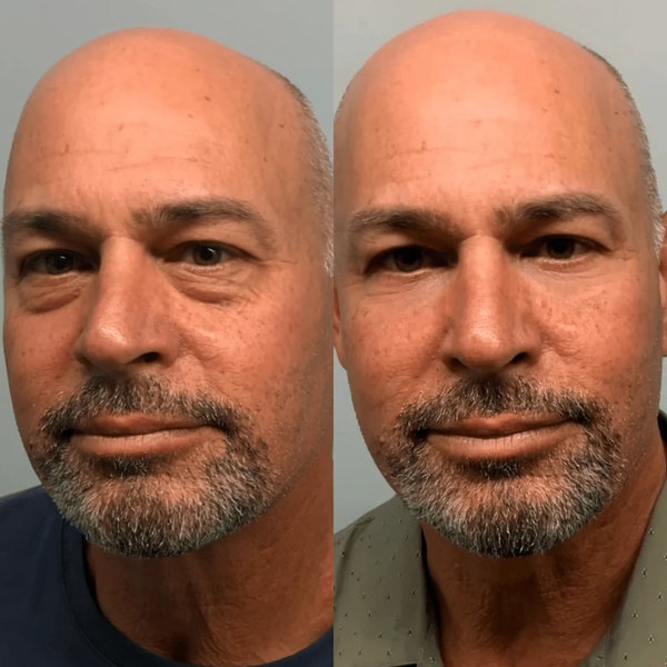 KireiEyes® 2-in-1 Red Light Therapy + EMS To Erase Eye Bags for Men