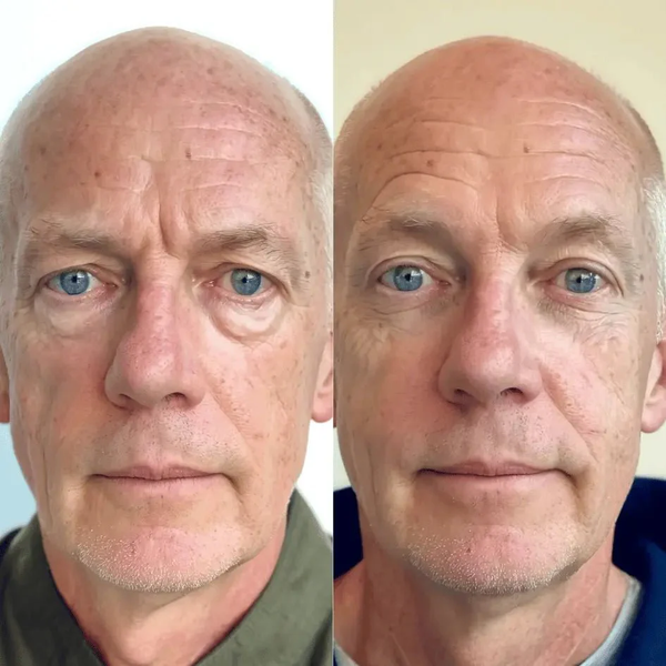 KireiEyes® 2-in-1 Red Light Therapy + EMS To Erase Eye Bags for Men