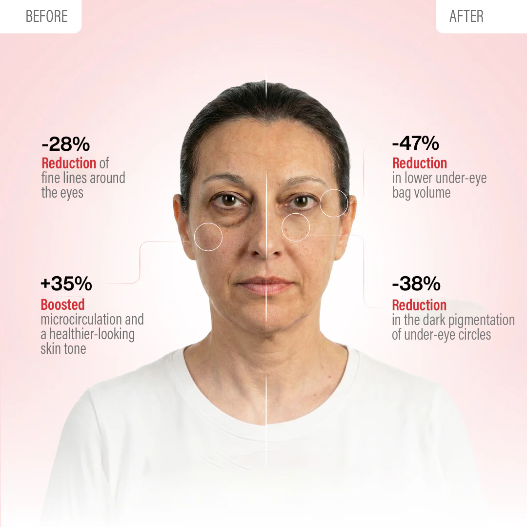 KireiEyes® 2-in-1 Rotlichttherapie + EMS zur Entfernung von Tränensäcken