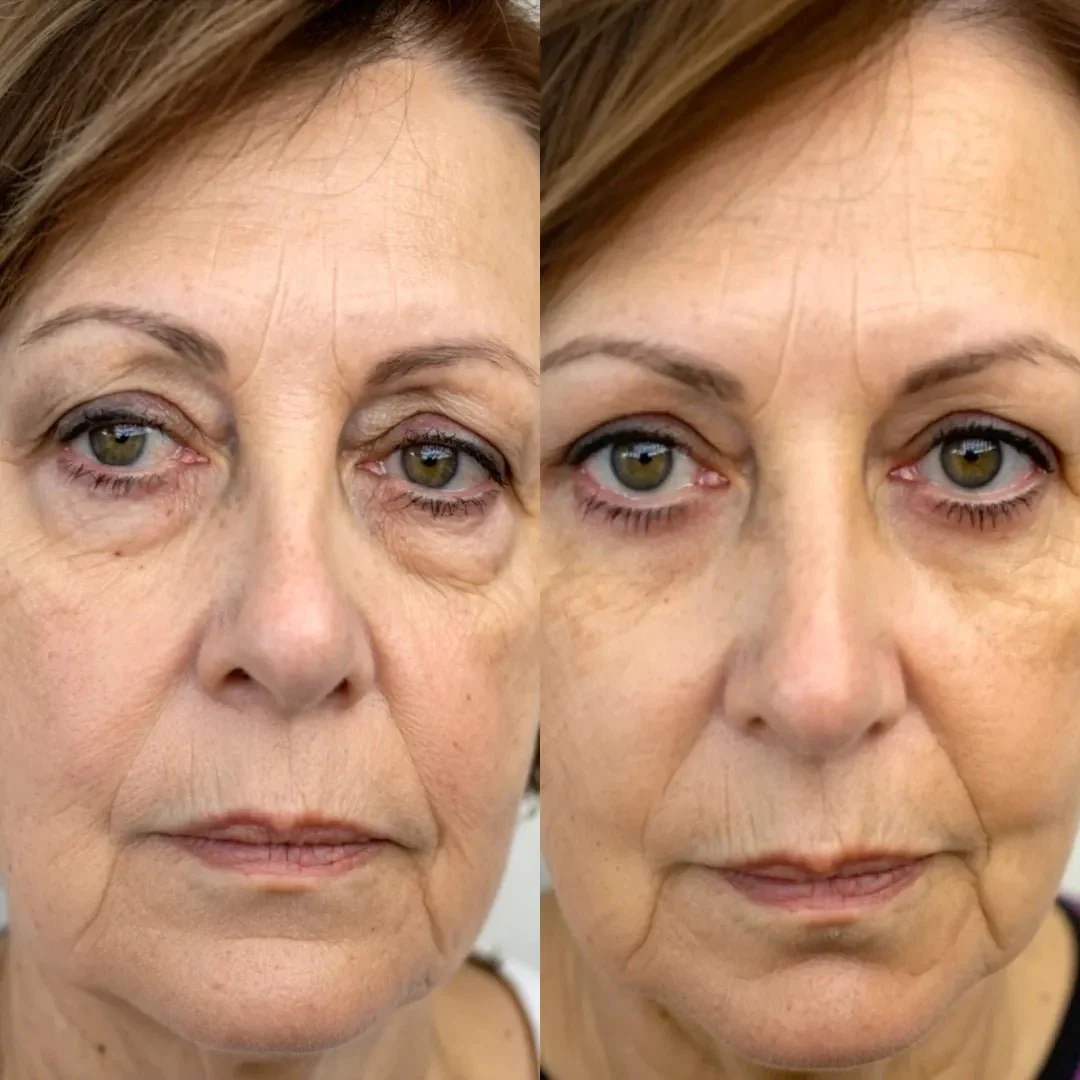 KireiEyes® 2-in-1 Rotlichttherapie + EMS zur Entfernung von Tränensäcken